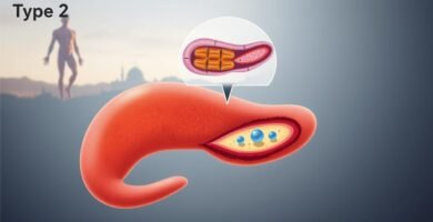 type 2 diabetes